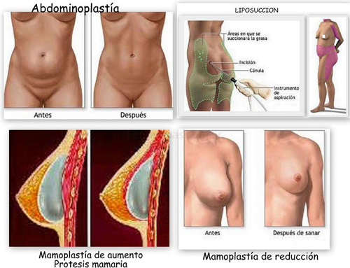 Drenaje linfático manual tras cirugía