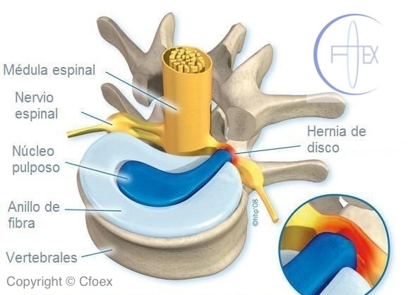 Osteopatía en Lumbago-Ciática-Protusión-Hernia Discal