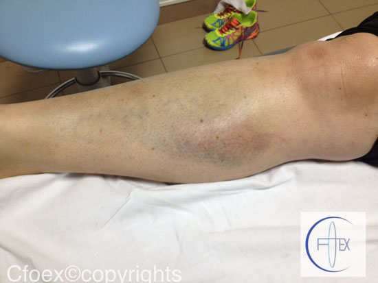 Hematoma tras rotura de fibras